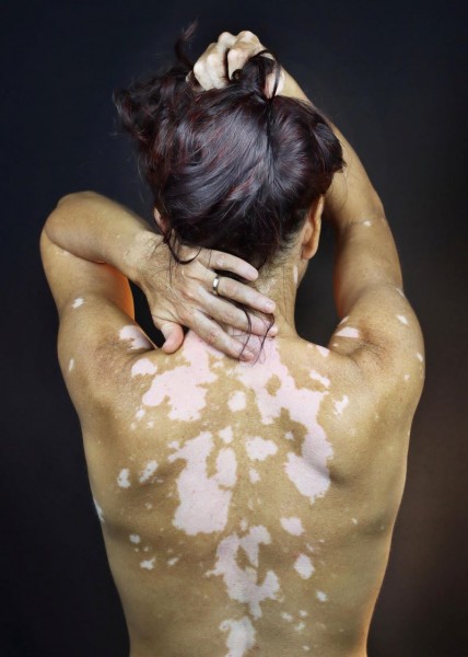 Vitiligo_Edne_Strenje_Jurcan__3_ 