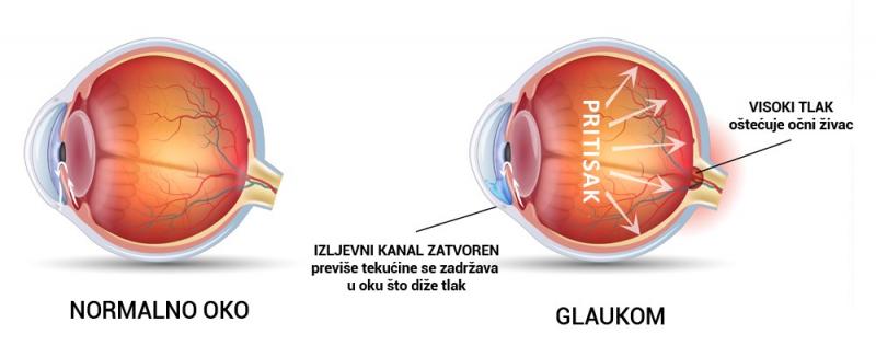 glaukom-ocni-tlak 
