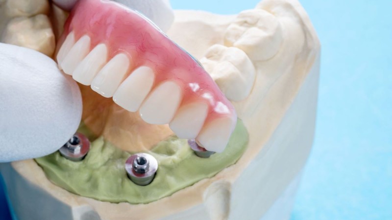 zubi_implantati_dentico-1 